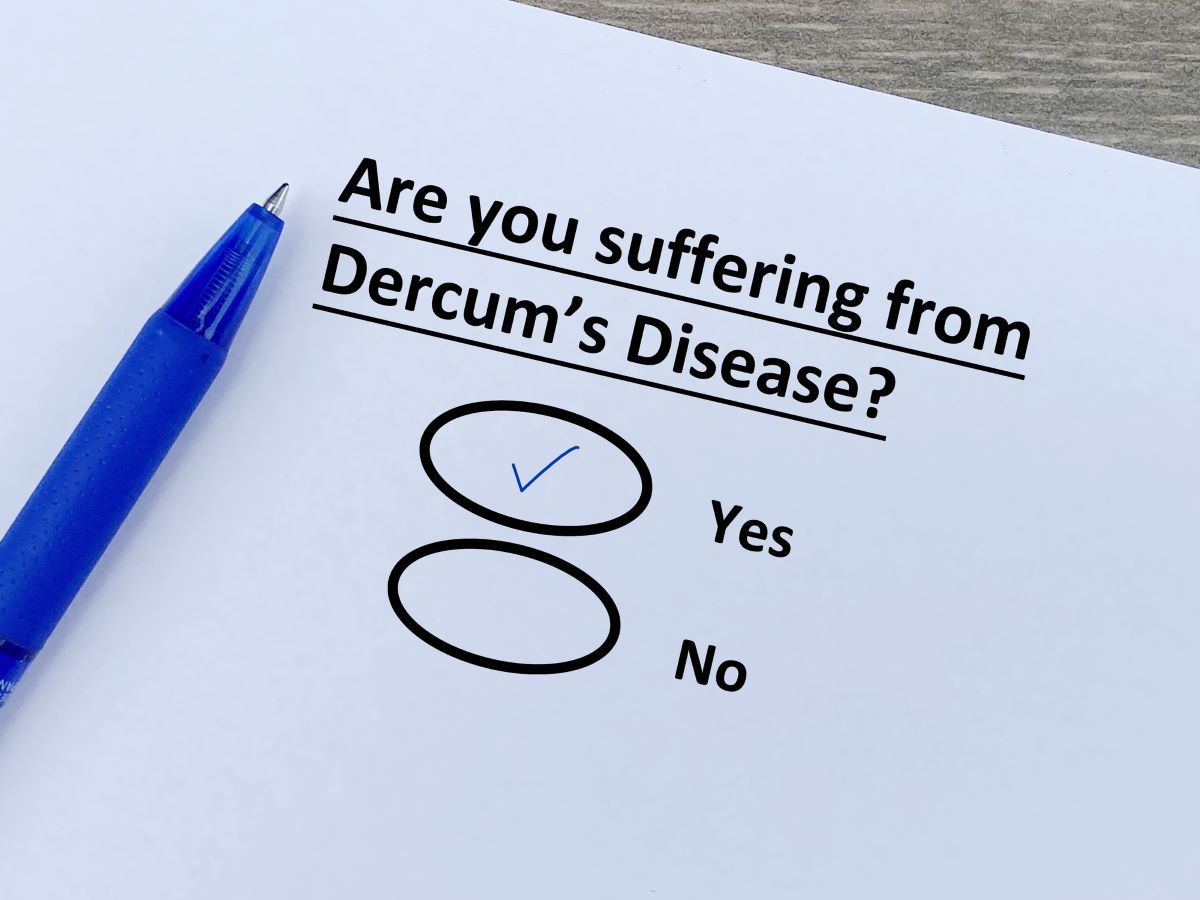 Dercums Disease